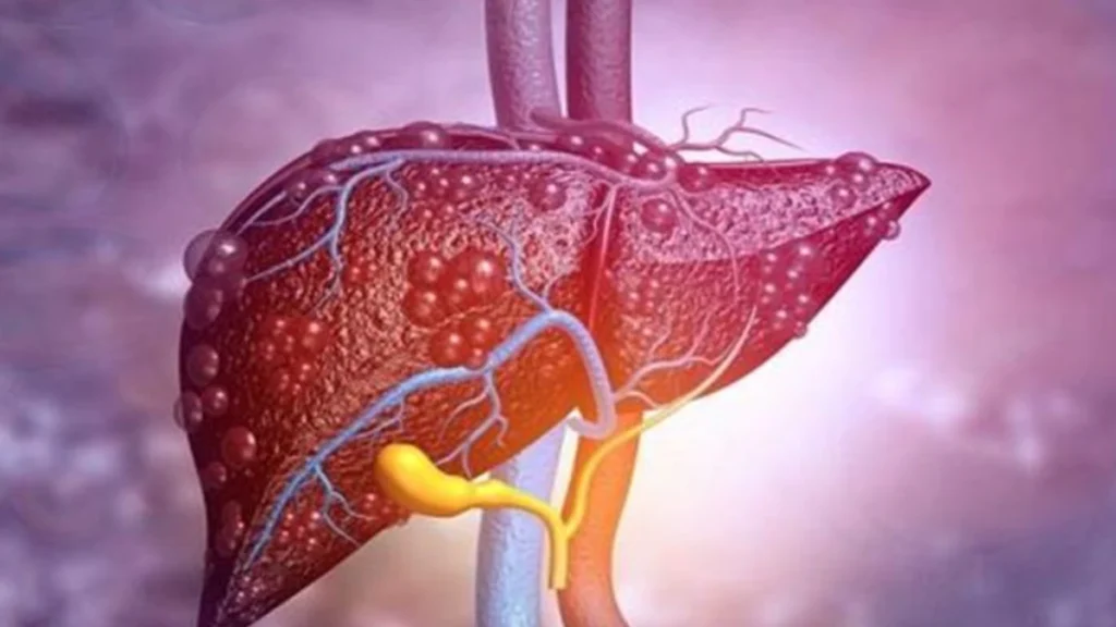Fatty liver