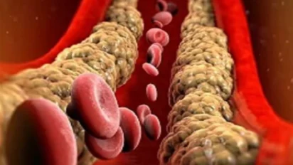 Winter Cholesterol Alert: सर्दियों में बढ़ सकता है कोलेस्ट्रॉल खतरा—जानें शुरुआती लक्षण और आसान बचाव उपाय