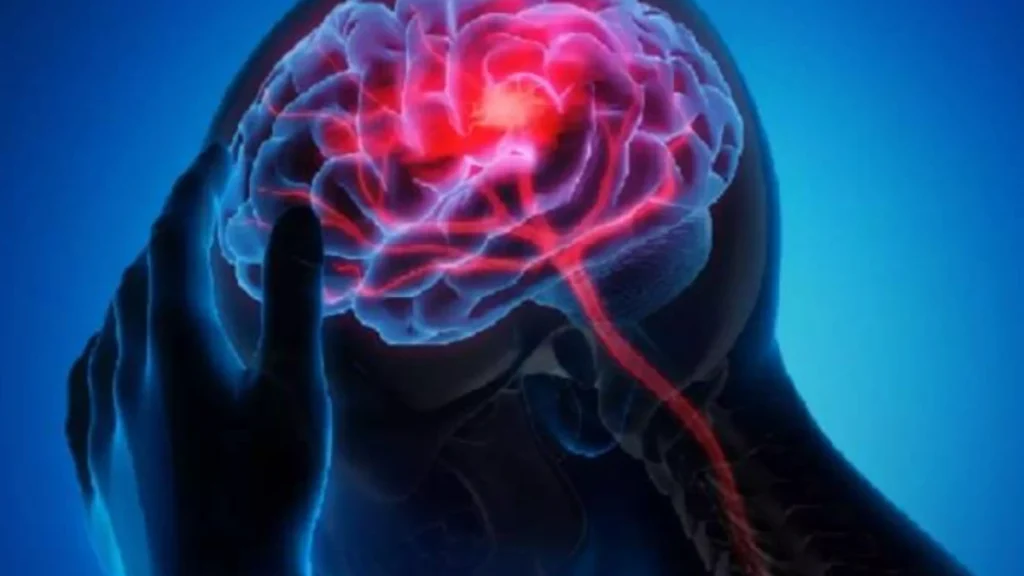 brain stroke