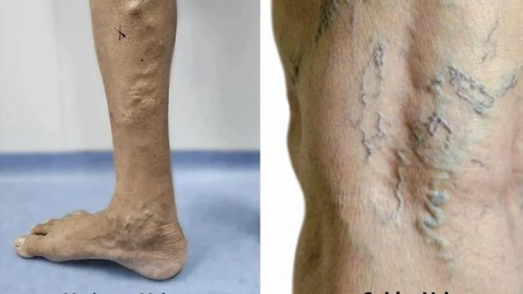 spider veins