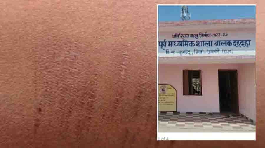 Dahadaha school incident: 35 students cut their wrists in Dhamtari, demanding the formation of a special investigation committee