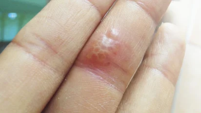हर्पेटिक विटलो (Herpetic Whitlow) क्या है? उंगलियों में तेज दर्द और छालों का कारण व बचाव